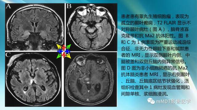 【PPT】副肿瘤神经综合征：小脑变性