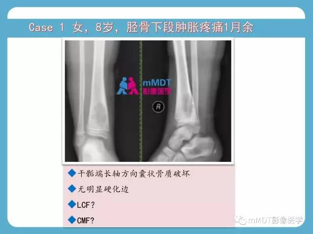 【PPT】软骨黏液样纤维瘤的影像诊断