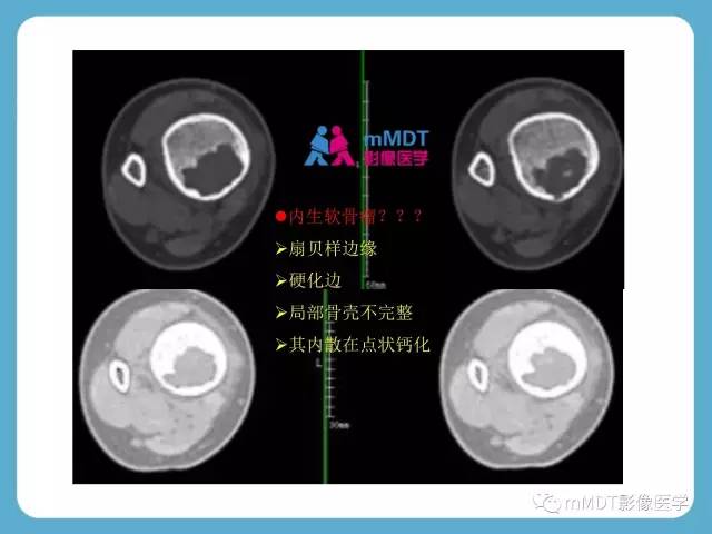 【PPT】软骨黏液样纤维瘤的影像诊断