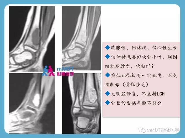 【PPT】软骨黏液样纤维瘤的影像诊断