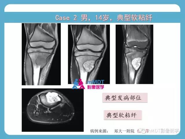 【PPT】软骨黏液样纤维瘤的影像诊断