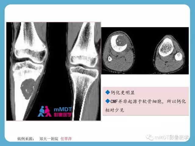 【PPT】软骨黏液样纤维瘤的影像诊断