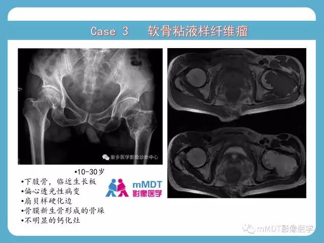 【PPT】软骨黏液样纤维瘤的影像诊断