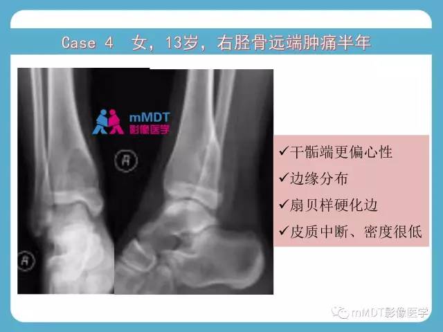【PPT】软骨黏液样纤维瘤的影像诊断