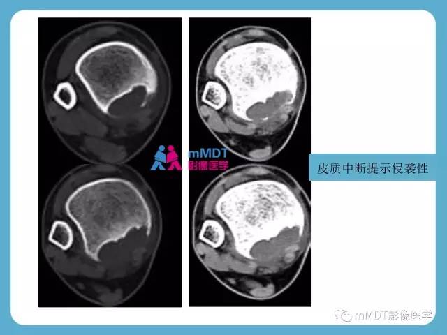【PPT】软骨黏液样纤维瘤的影像诊断