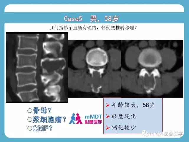 【PPT】软骨黏液样纤维瘤的影像诊断
