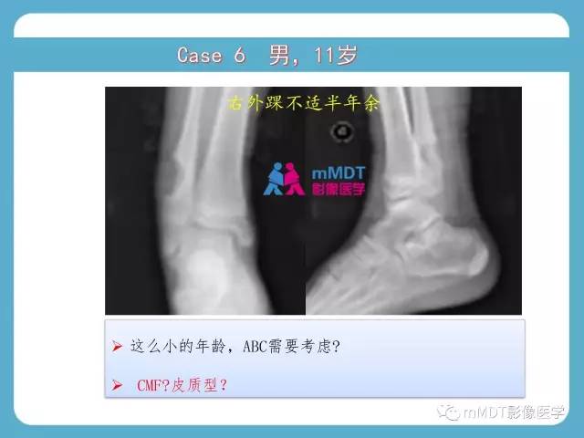 【PPT】软骨黏液样纤维瘤的影像诊断