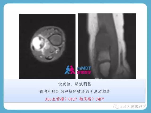 【PPT】软骨黏液样纤维瘤的影像诊断