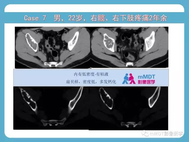 【PPT】软骨黏液样纤维瘤的影像诊断