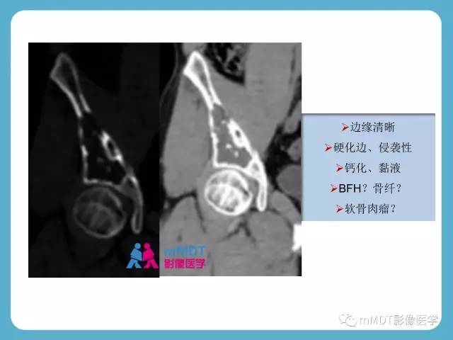 【PPT】软骨黏液样纤维瘤的影像诊断