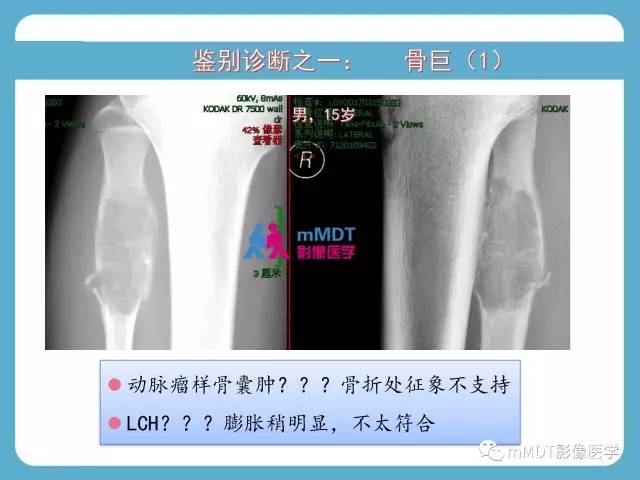 【PPT】软骨黏液样纤维瘤的影像诊断