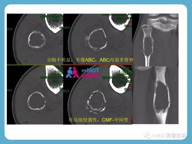 【PPT】软骨黏液样纤维瘤的影像诊断