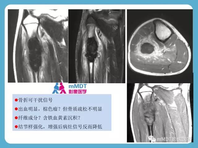 【PPT】软骨黏液样纤维瘤的影像诊断