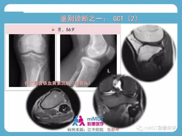 【PPT】软骨黏液样纤维瘤的影像诊断