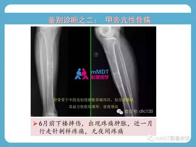 【PPT】软骨黏液样纤维瘤的影像诊断