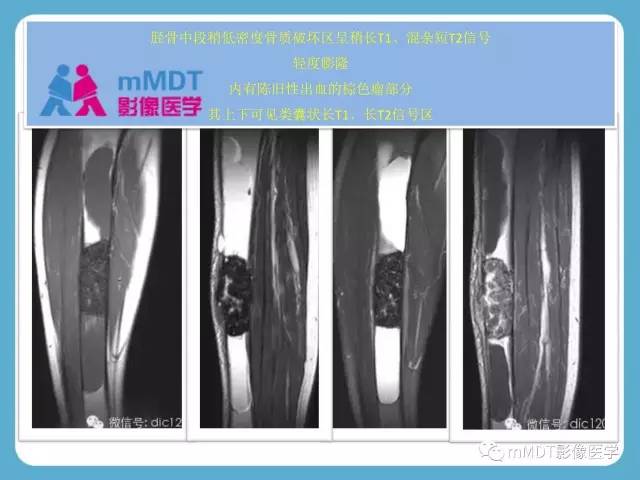 【PPT】软骨黏液样纤维瘤的影像诊断