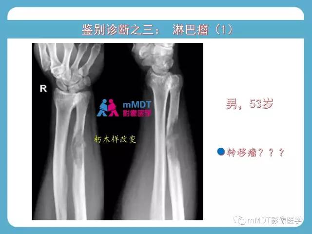 【PPT】软骨黏液样纤维瘤的影像诊断