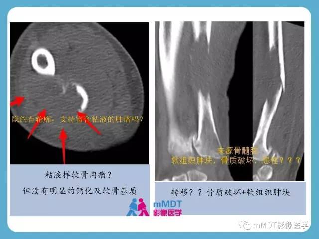 【PPT】软骨黏液样纤维瘤的影像诊断
