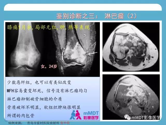 【PPT】软骨黏液样纤维瘤的影像诊断