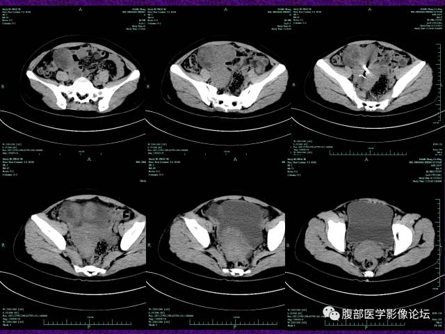 【病例】小肠间质瘤1例CT