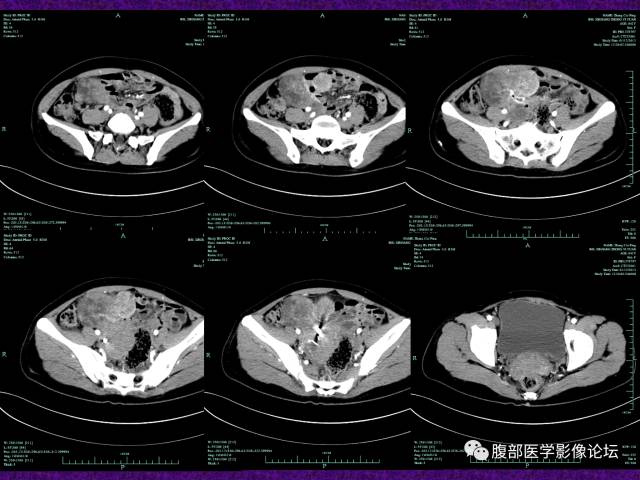 【病例】小肠间质瘤1例CT