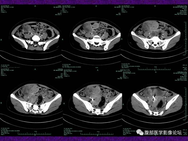 【病例】小肠间质瘤1例CT