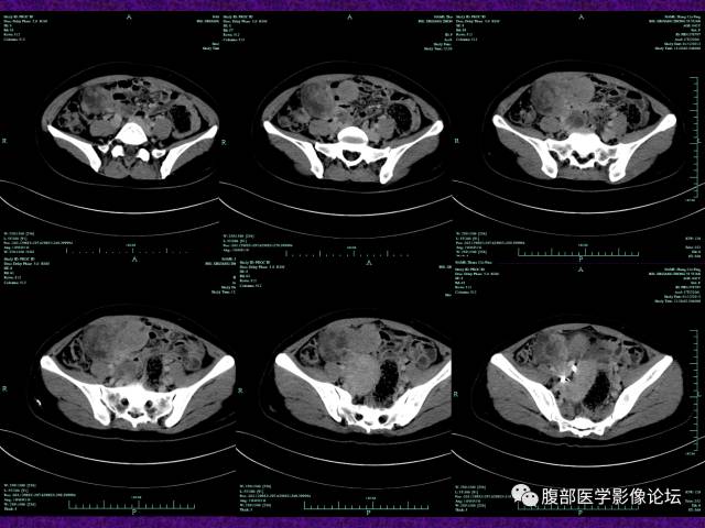 【病例】小肠间质瘤1例CT