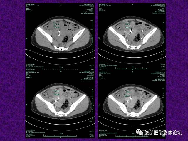 【病例】小肠间质瘤1例CT