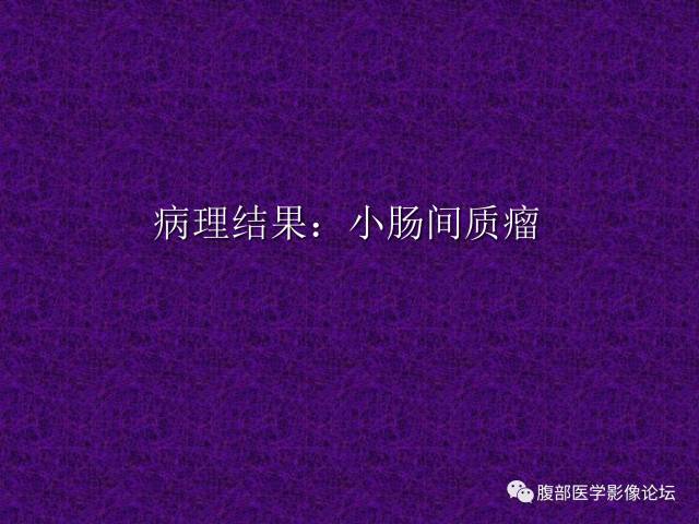 【病例】小肠间质瘤1例CT