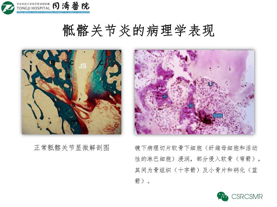 【PPT】各种影像技术对诊断骶髂关节炎的价值