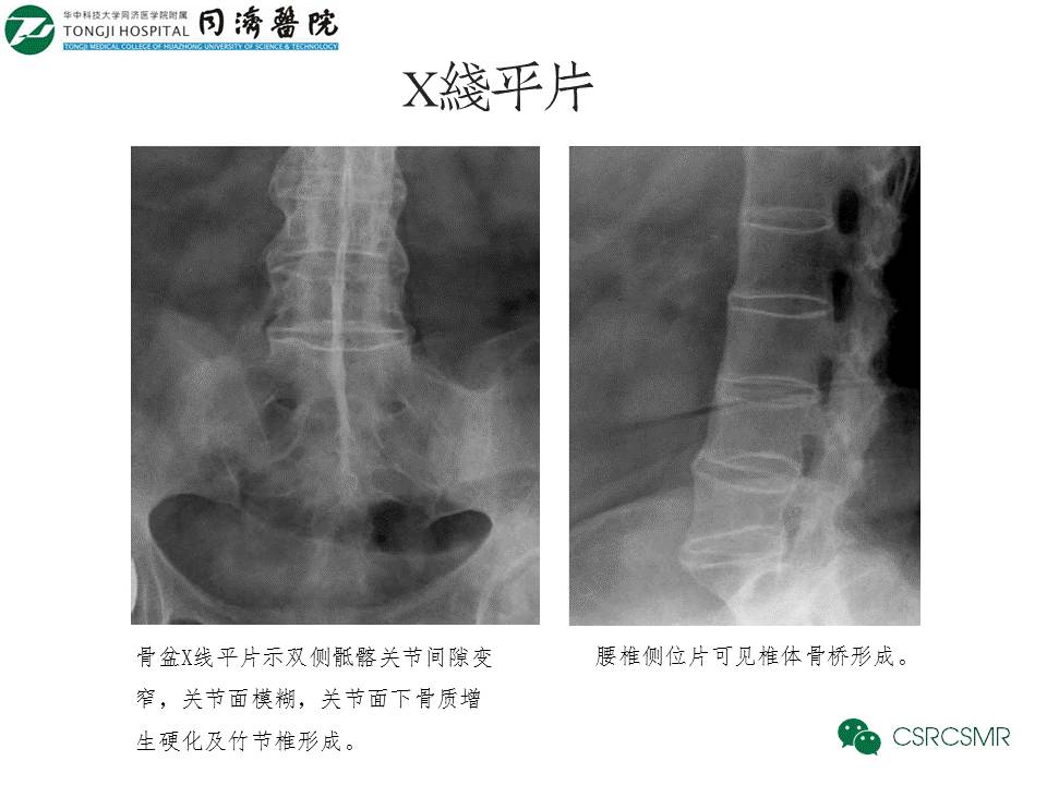 【PPT】各种影像技术对诊断骶髂关节炎的价值