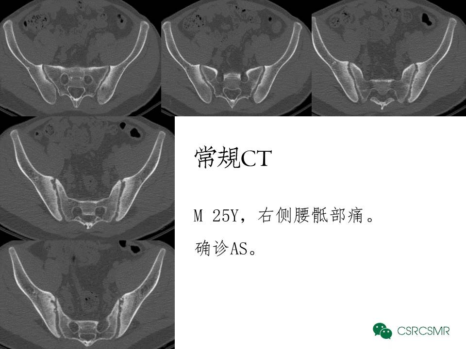 【PPT】各种影像技术对诊断骶髂关节炎的价值