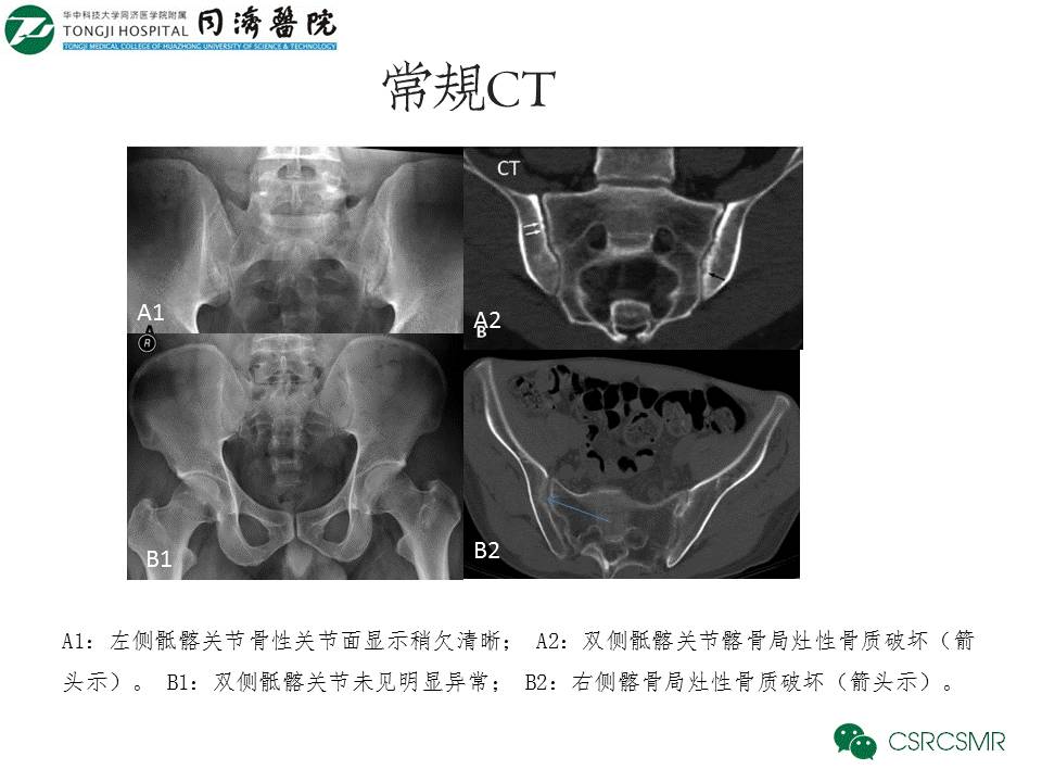 【PPT】各种影像技术对诊断骶髂关节炎的价值
