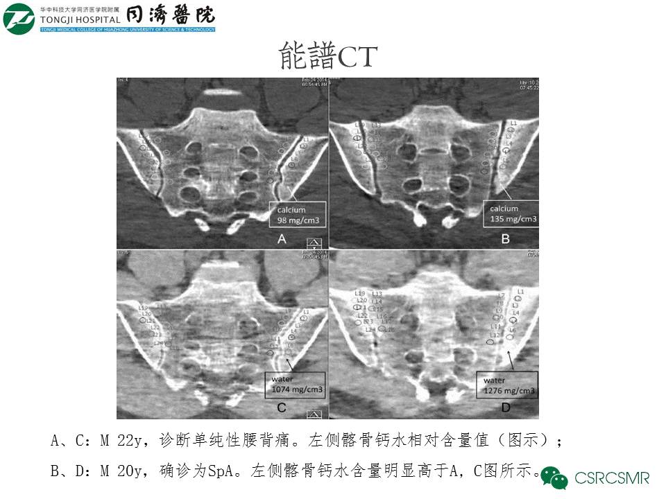 【PPT】各种影像技术对诊断骶髂关节炎的价值