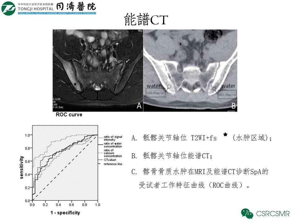 【PPT】各种影像技术对诊断骶髂关节炎的价值