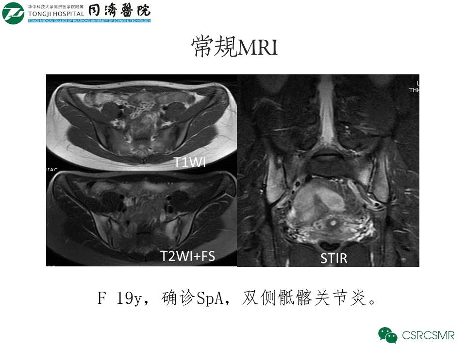 【PPT】各种影像技术对诊断骶髂关节炎的价值