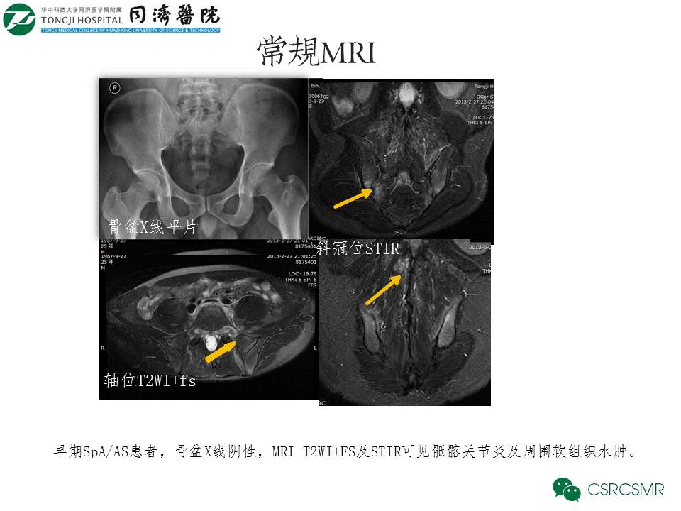 【PPT】各种影像技术对诊断骶髂关节炎的价值