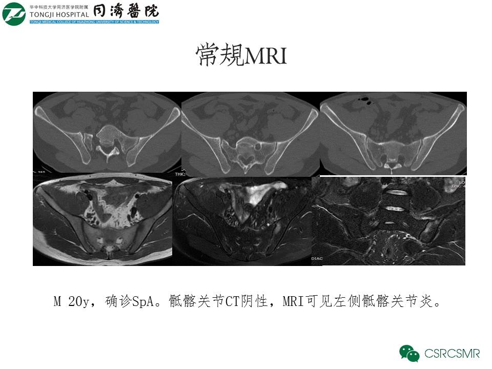 【PPT】各种影像技术对诊断骶髂关节炎的价值