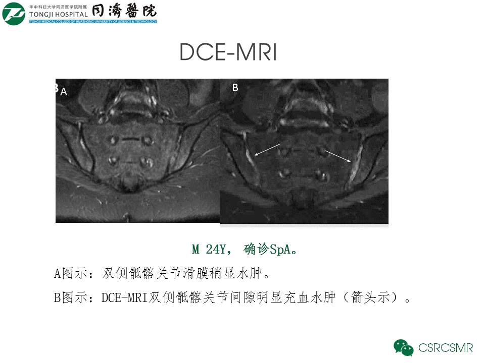 【PPT】各种影像技术对诊断骶髂关节炎的价值