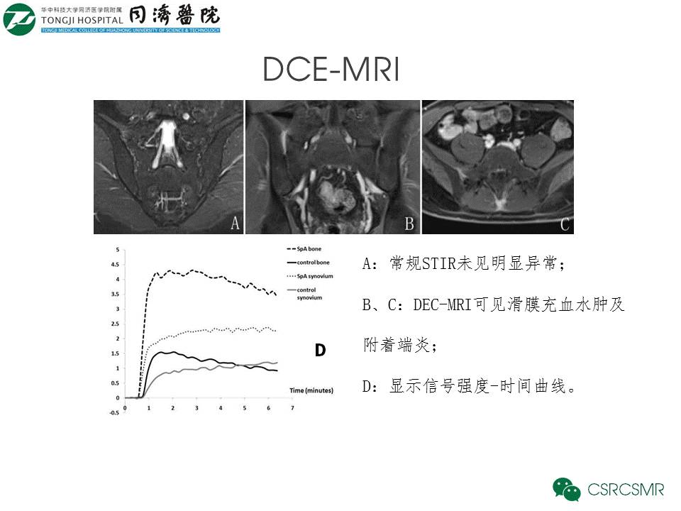 【PPT】各种影像技术对诊断骶髂关节炎的价值