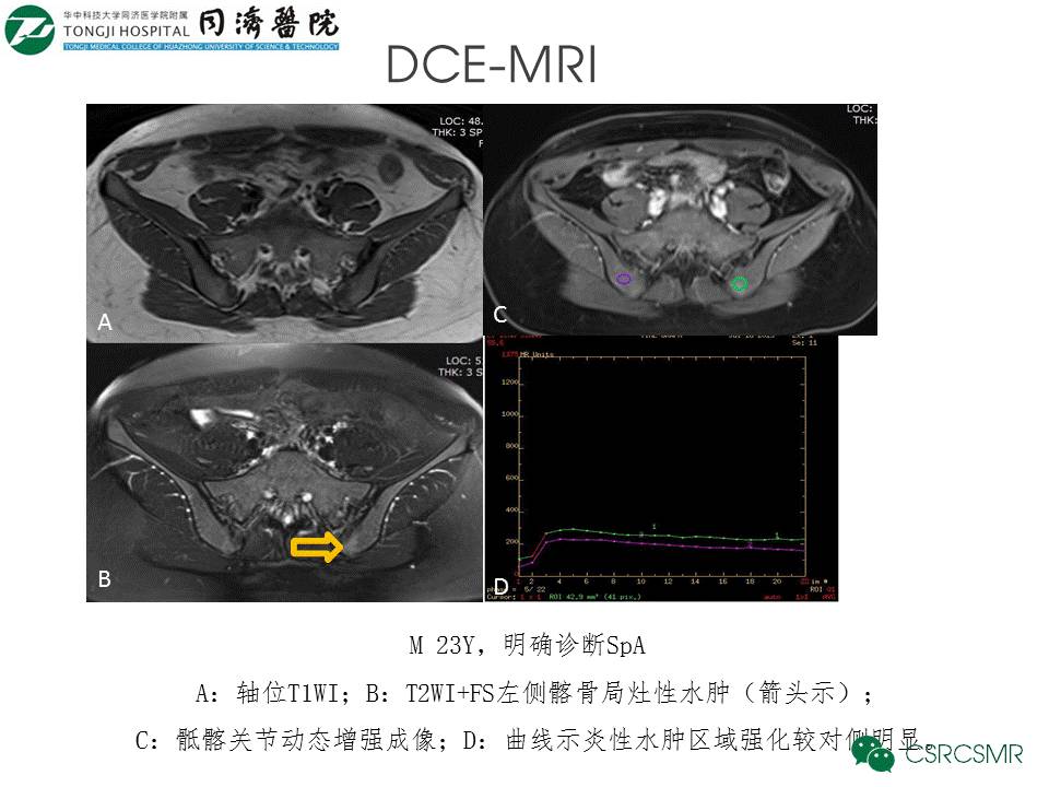 【PPT】各种影像技术对诊断骶髂关节炎的价值