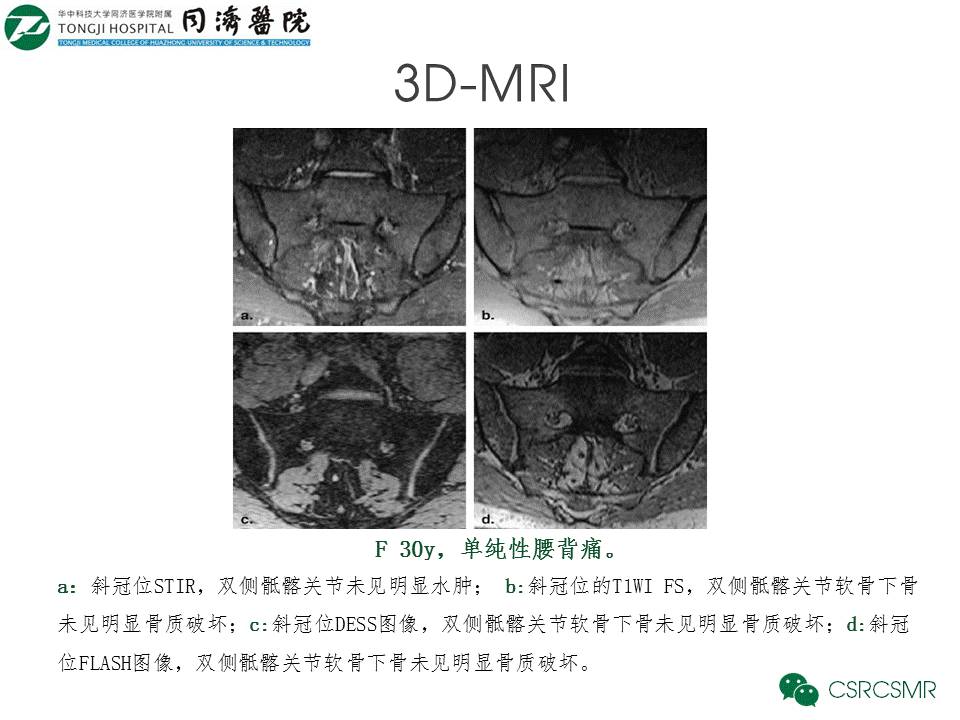 【PPT】各种影像技术对诊断骶髂关节炎的价值