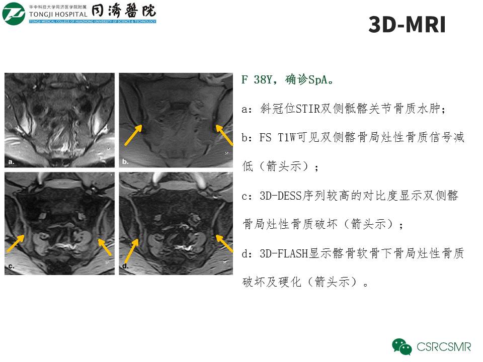 【PPT】各种影像技术对诊断骶髂关节炎的价值