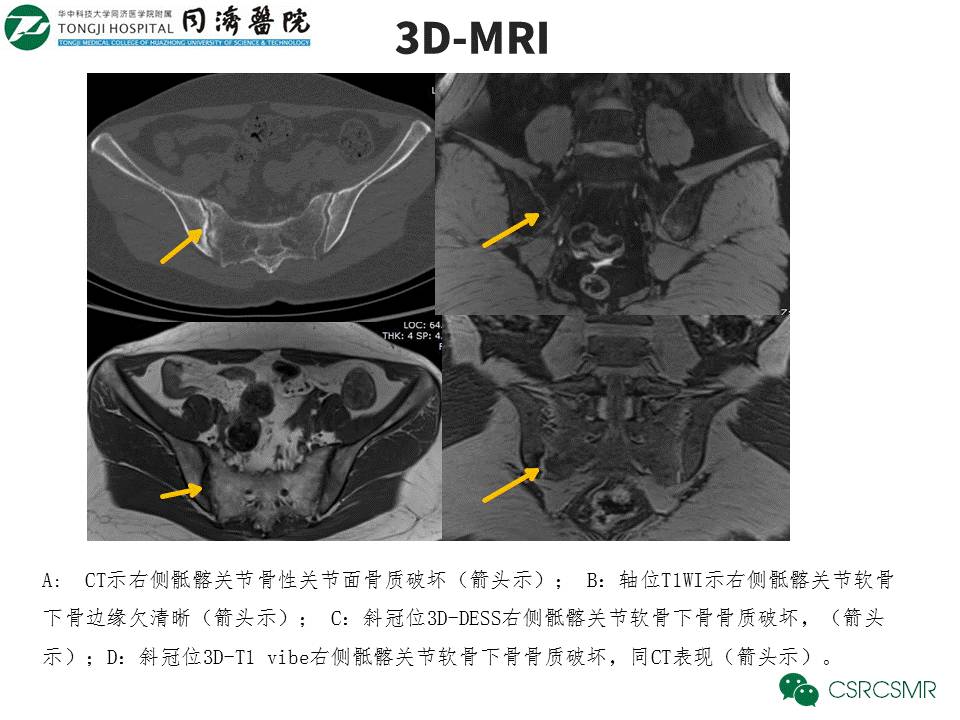 【PPT】各种影像技术对诊断骶髂关节炎的价值