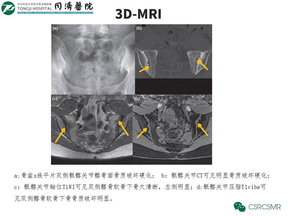 【PPT】各种影像技术对诊断骶髂关节炎的价值