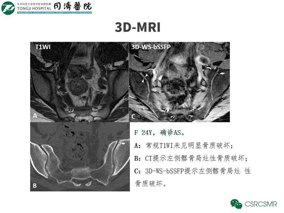 【PPT】各种影像技术对诊断骶髂关节炎的价值