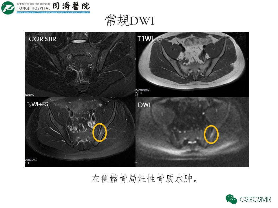 【PPT】各种影像技术对诊断骶髂关节炎的价值