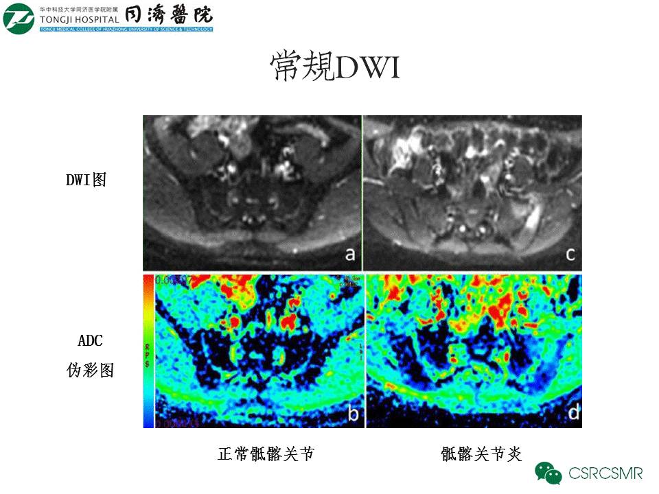 【PPT】各种影像技术对诊断骶髂关节炎的价值
