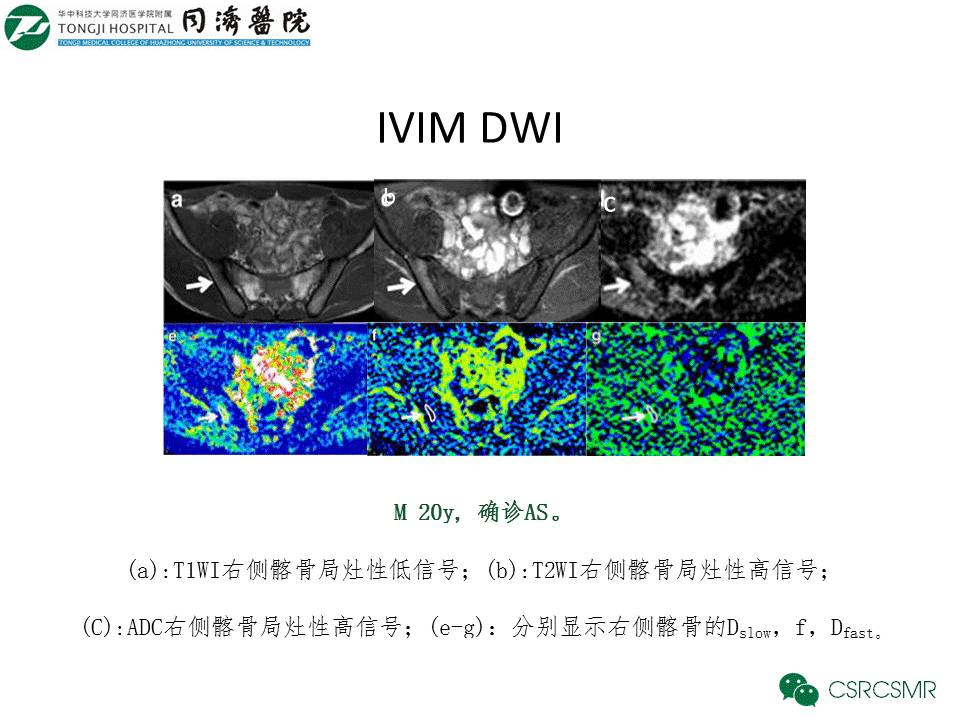 【PPT】各种影像技术对诊断骶髂关节炎的价值