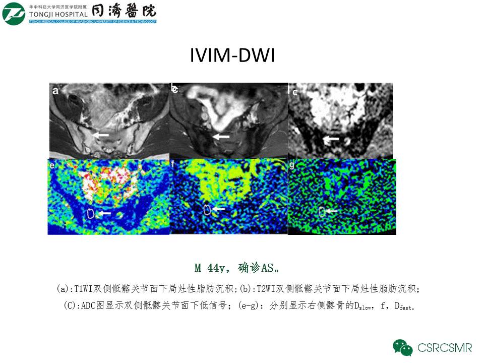 【PPT】各种影像技术对诊断骶髂关节炎的价值